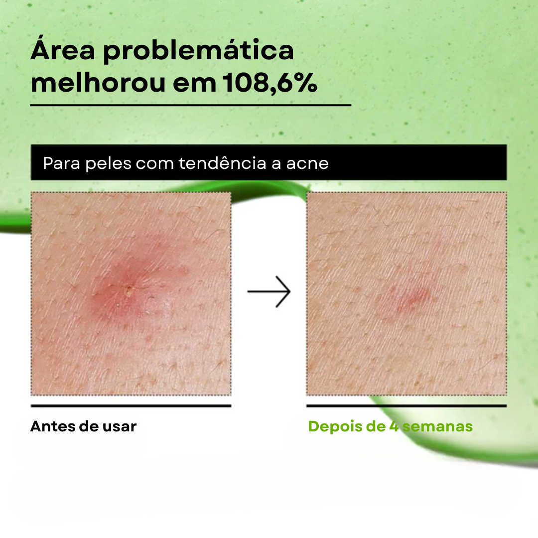 Sérum Anua Calmante com Ácido Azelaico 10% e Ácido Hialurônico