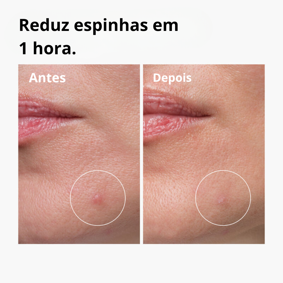 The Ordinary Sulfur 10% Tratamento Antiacne com Enxofre
